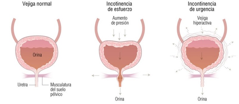 incontingencia urinaria
